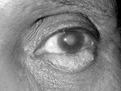 Blepharitis