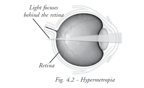  Hypermetropia 