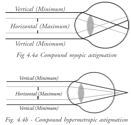 astigmatism hypermetropic