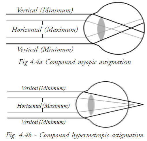  Compound Astigmatism 