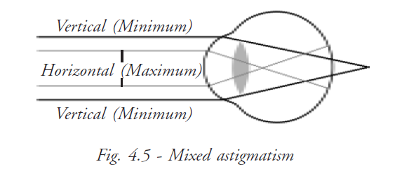  Mixed Astigmatism 