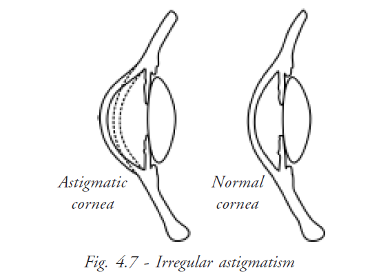  Simple Astigmatism 