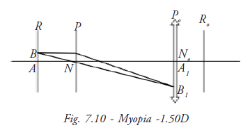  Myopia -  1.50 D 