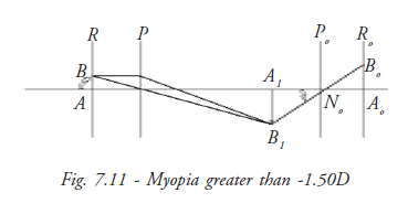 Myopia greater than -1.50 D
