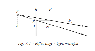 Reflex Stage Hypermetropia