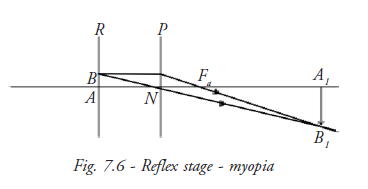 Reflex Stage Myopia