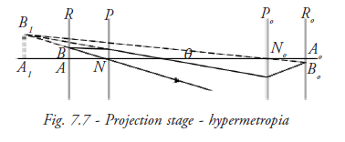 Projection Stage Hypermetropia