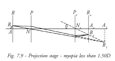 Projection Stage Myopia Less than 1.50 D