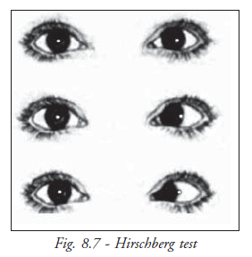 Hirschberg Test